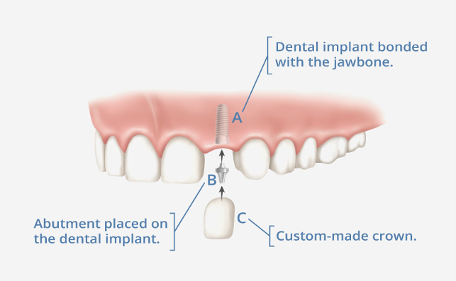 taylorsville implant center