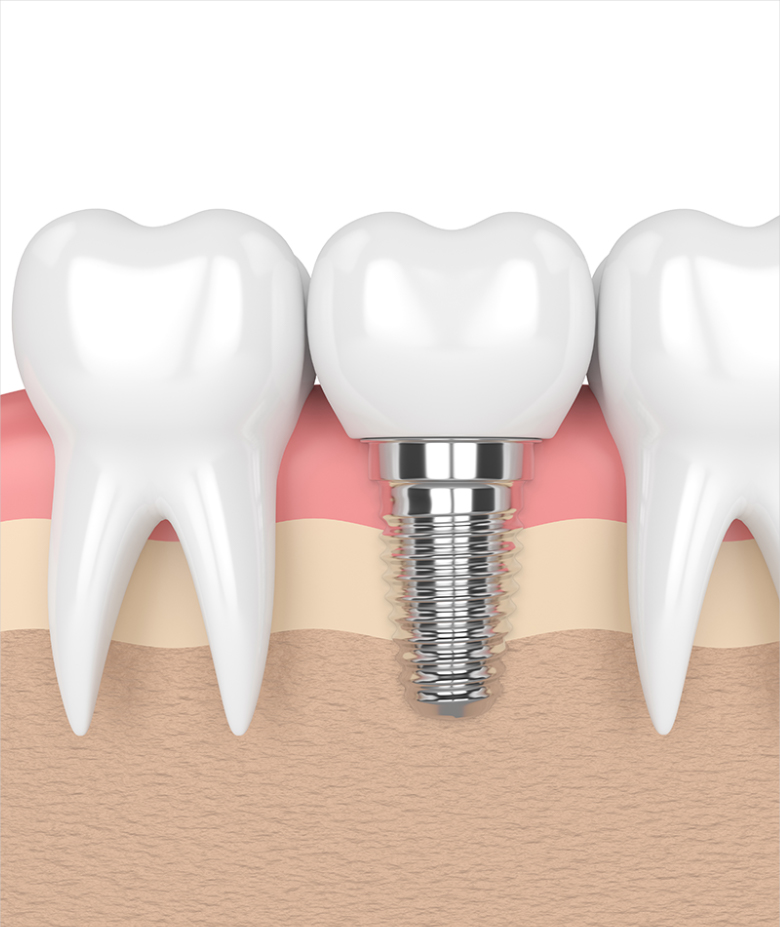 single-tooth-implant